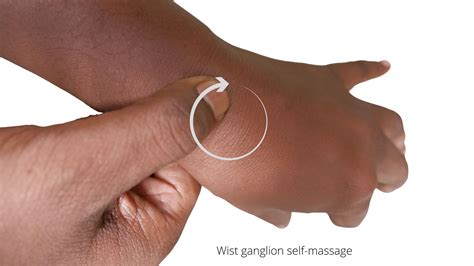 These 3 Easy Ganglion Cyst Wrist Exercises will Remove Lump Without Surgery