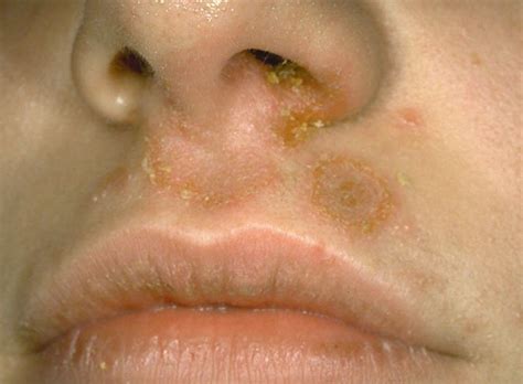 Staph Infection On Lips