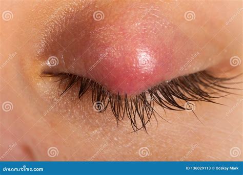 Hordeolum on Upper Eyelid. Viral Infection Stock Image - Image of ...