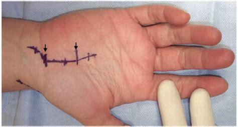 Surgical Options for Recurrent Carpal Tunnel Syndrome | Musculoskeletal Key