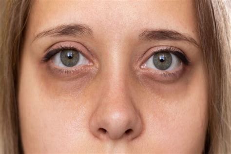 Dark Circles Under the Eyes: Causes, Treatment & Prevention | MyVision.org