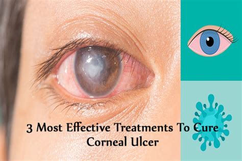 Diagnosis and Treatment of Corneal Ulcers | OBN