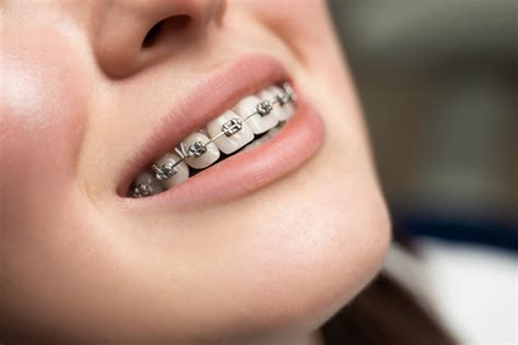 Types of Braces - Bellevue Orthodontics & Smile Design - Bellevue, WA