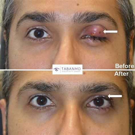 Chalazion Removal Beverly Hills | Stye Surgery Los Angeles