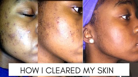 HOW I CLEARED MY SKIN // acne prone skin - YouTube