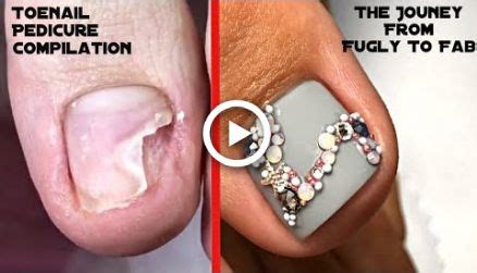 Gross Toenail Transformed Into Pretty Nails - Toe Nail Art Tutorial Best Foot Pedicure | Toe ...