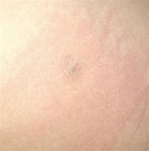 First four weeks of my brown recluse bite. Very eager for the necrotic tissue to fall out. : r ...