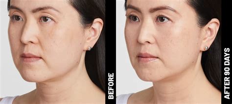 Ultherapy Before and After - Brows, Neck, Chest & Chin - Ultherapy