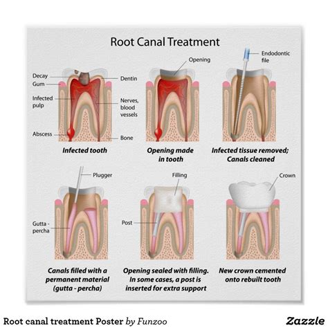 Pin on Wisdom Teeth Swelling