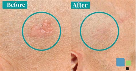 mole removal near me prices - Loma Rhoades