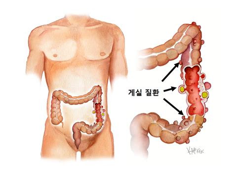 게실질환 | 대장 외과 의사 시드니