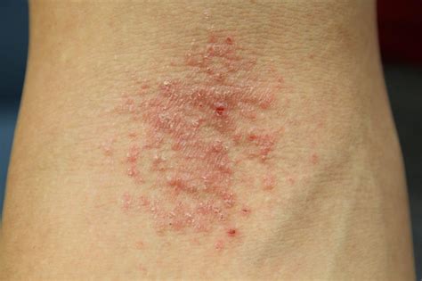 Shingles Vs Eczema Rash at Roseann Mixon blog