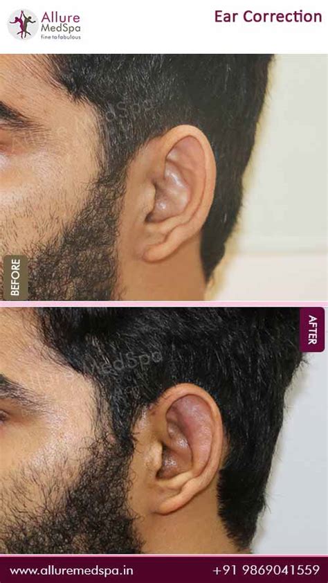 Ear Surgery, Otoplasty Cost in Mumbai, India - Allure Medspa