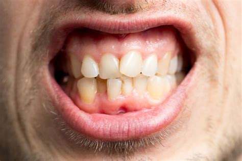 Crooked teeth? They could hurt more than just your self-esteem | health ...