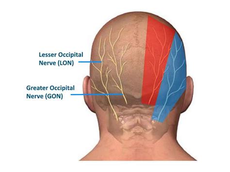 Occipital Neuralgia: Symptoms, Diagnosis, and Treatment