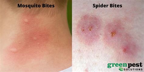 How to Tell a Spider Bite from a Mosquito Bite: What to Look for in ...