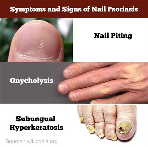 Discover 135+ nail psoriasis images super hot - ceg.edu.vn