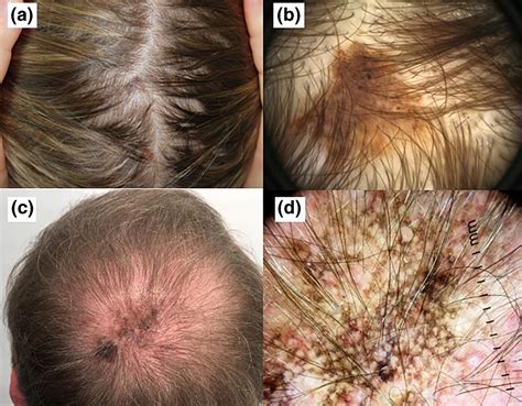 Melanoma scalp photos | Symptoms and pictures