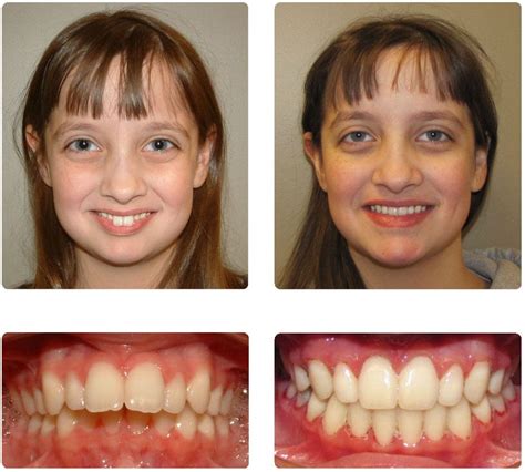 How To Cure Overbite - Proofcheek Spmsoalan