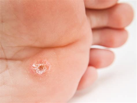 Plantar Wart Root Depth | Bruin Blog