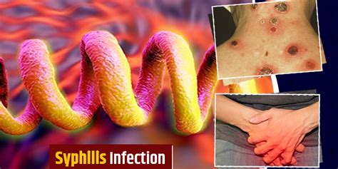 Syphilis Infection: Know Symptoms And Stages Of This Bacterial ...