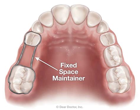 Space Maintainers | Barbara J. Utermark, D.M.D. | Martinez Georgia