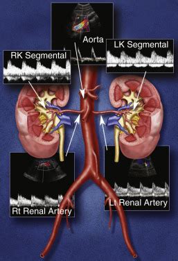 Duplex Ultrasound of Native Renal Vasculature | Radiology Key