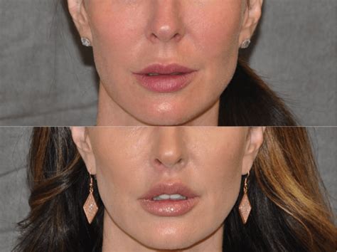 The Lip Lift is a cosmetic surgery that enhances the look of the entire face. Our Doctors are ...