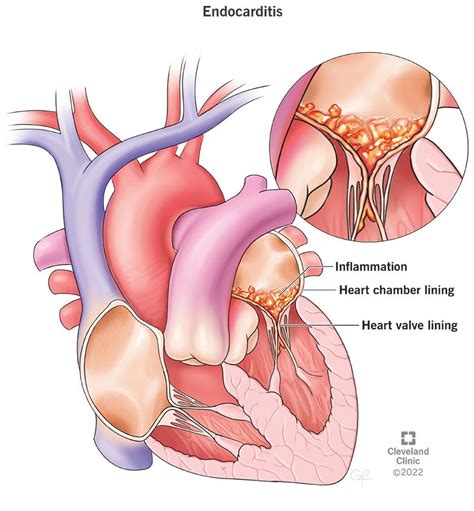 Acute Infective Endocarditis