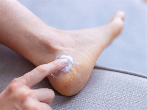 Home Remedies for Cracked Heels in Winter