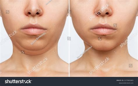 355 Chin Reduction Surgery Images, Stock Photos & Vectors | Shutterstock