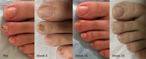 Images before and after 12 treatment sessions for toenail onychomycosis. | Download Scientific ...