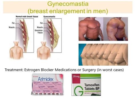 Gynecomastia Symptoms: Diagnosis and Treatment