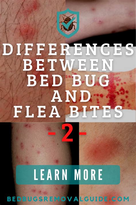 Differences Between Bed Bug and Flea Bites-2 | Bed bug bites, Bed bug bites remedies, Bed bugs