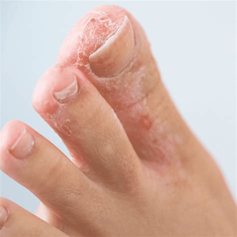 Athlete's Foot: Symptoms, Causes & Treatment | The Feet People