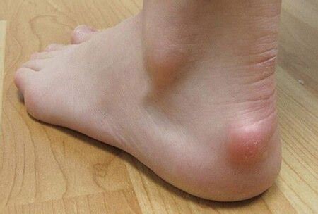 Lump On Left Foot Outlet | emergencydentistry.com