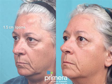 Cyst Removal Before and After Pictures Case 896 | Orlando, Florida | Primera Plastic Surgery
