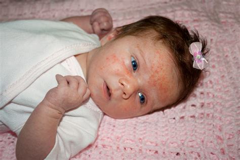 Is It a Rash or Baby Acne? - WeHaveKids