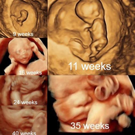 2D Gender - Early View Ultrasound