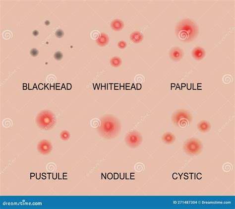 Different Types of Acne. Acne Skin Types. Blackheads, Whiteheads ...