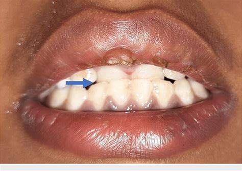 Figure 1 from Management of Laterally Luxated Primary Teeth: A Case Report | Semantic Scholar