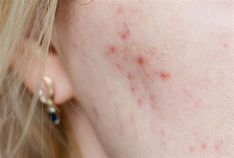 Cystic Acne: Causes, Symptoms, & Medical Treatment