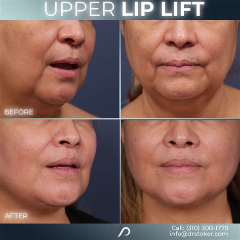 We rejuvenated our pretty patient in her 60s, with an upper lip lift and buccal fat pad ...