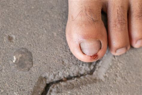 Toe Injuries are Caused by Carelessness while Walking, Causing the Toes To Be Injured and ...