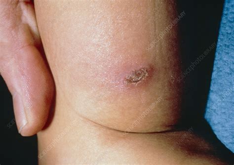 Child abuse: wound caused by cigarette burn - Stock Image - M330/0108 ...