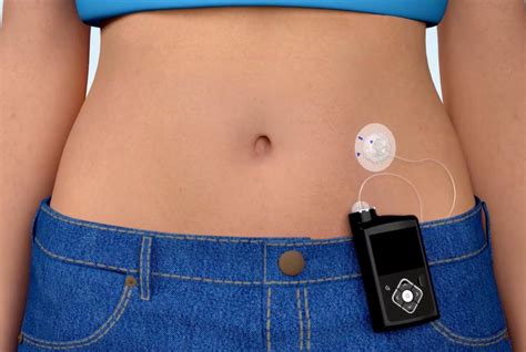 Insulin Pump Therapy | Medtronic Diabetes