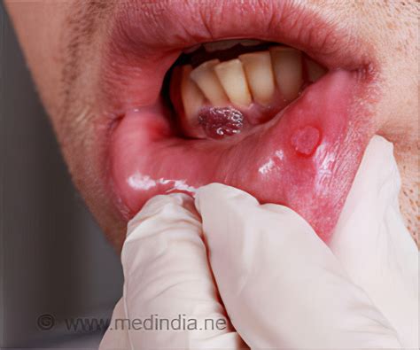 Oral Cancer Lip