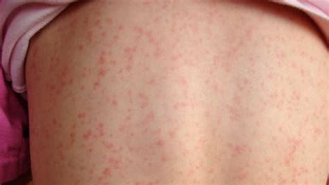Scarlet Fever: Symptoms, Causes, Complications, and Treatment