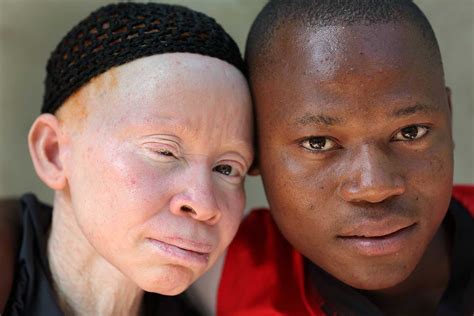 Protect the Rights of People with Albinism - iLiveWell