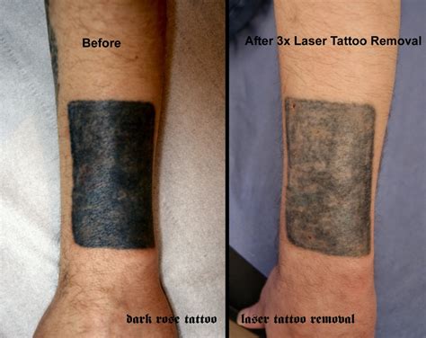 Laser Tattoo Removal On Black Skin / Laser Tattoo Removal - New Look Skin Center Glendale ...